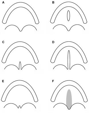 Non-syndromic Cleft Palate: An Overview on Human Genetic and Environmental Risk Factors